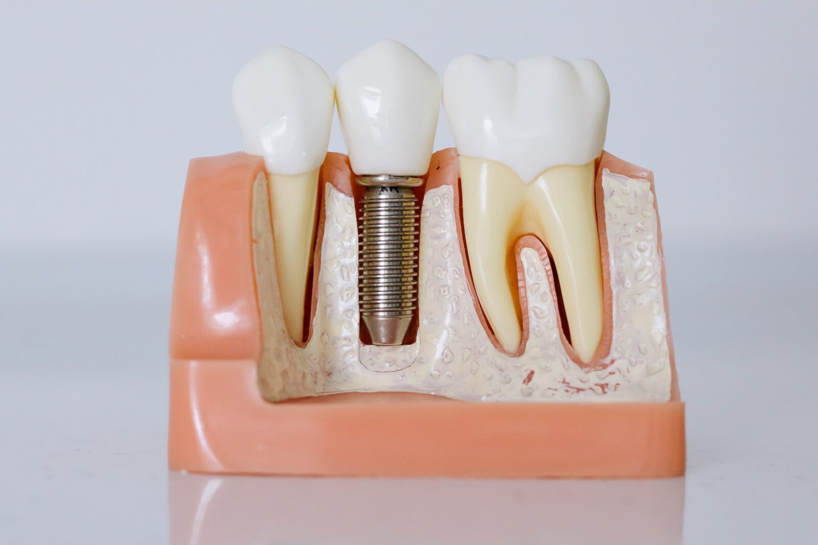 Implanty i protetyka stomatologiczna