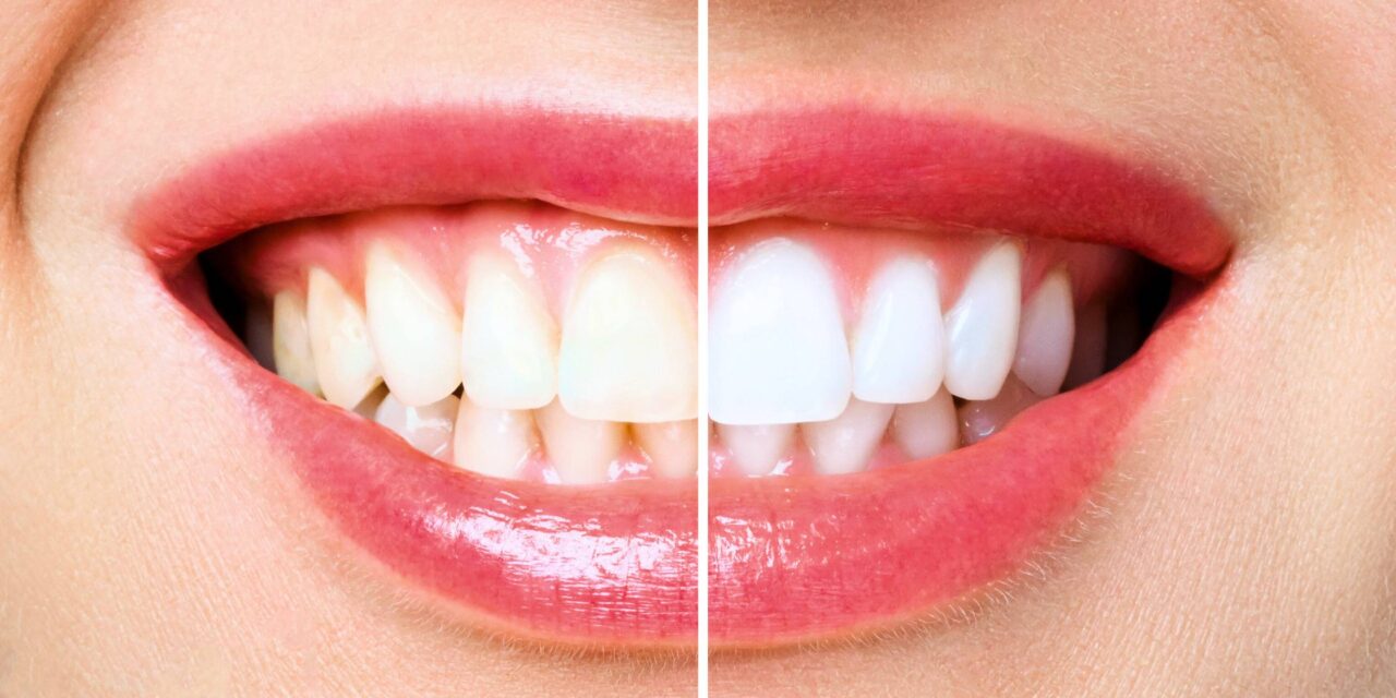 Skuteczne Wybielanie Zębów: Przewodnik po Sprawdzonych Metodach